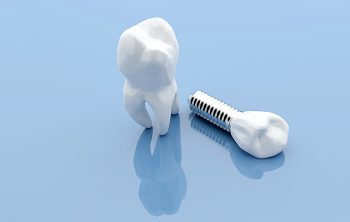 Why You Should Opt for Dental Implants to Fix Tooth Loss