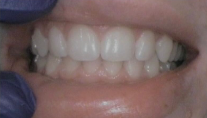 Up-close photo of our patient's teeth after invisalign treatment