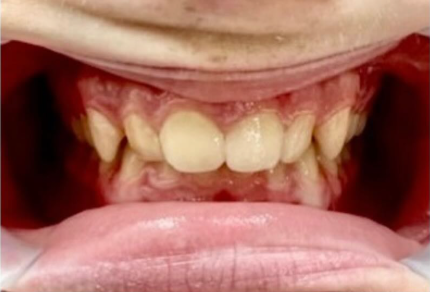 Up-close photo of our patient's teeth before invisalign treatment