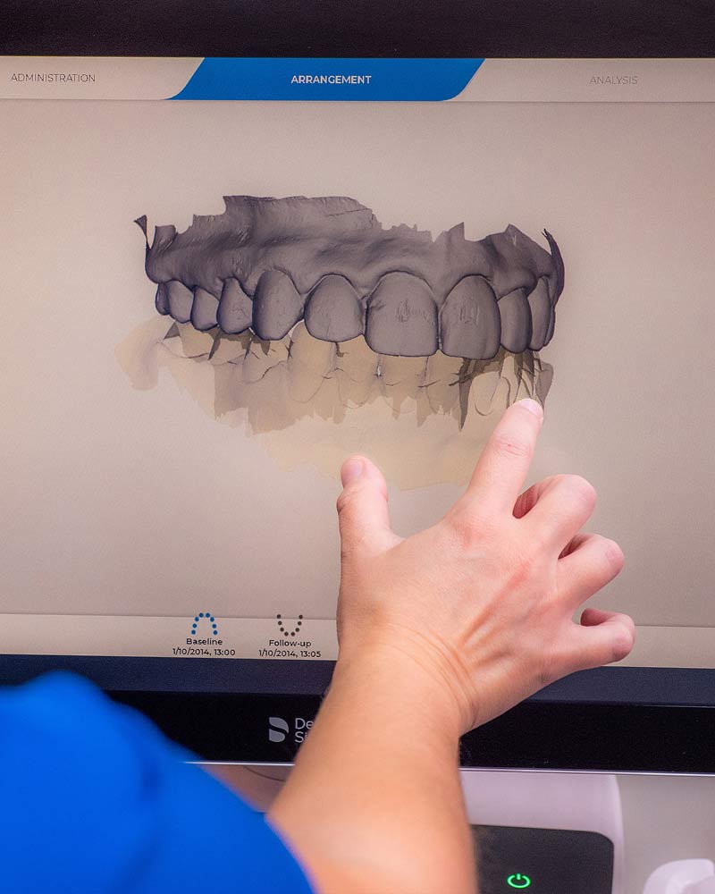 Invisalign offered at Roman Dental Arts in Hackensack, NJ