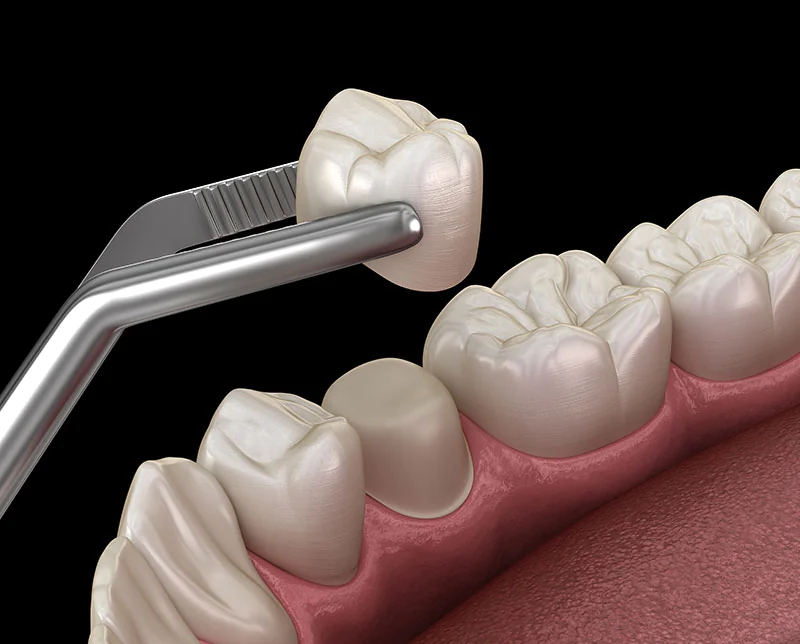 3D model showing crowns being placed